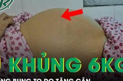 Tưởng bụng to do tăng cân, người phụ nữ phát hiện khối u nặng 6kg