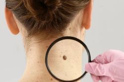 Những dấu hiệu cảnh báo ung thư da, nhiều người chủ quan thường hay bỏ qua