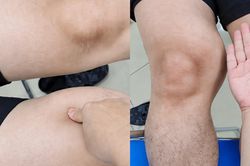 Đùi to bất thường nhưng không đau, người đàn ông 39 tuổi phát hiện ung thư mô mềm hiếm gặp