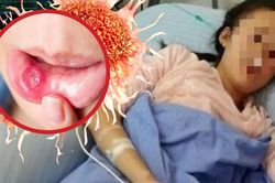 Cô gái 26 tuổi 'chết lặng' phát hiện ung thư giai đoạn 3 khi khám nhiệt miệng