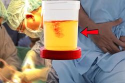 Người đàn ông phải cắt bỏ bàng quang vì một dấu hiệu bị bỏ qua quá lâu