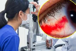 Bé gái 12 tuổi bị dây cáp quẹt vào mắt rách võng mạc