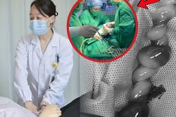 Bác sĩ kể khoảnh khắc sinh tử cứu thai nhi dây rốn xoắn tới 40 vòng