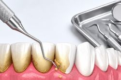 Lấy cao răng có được bảo hiểm y tế chi trả không?