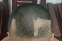 Đã cắt tóc '3 phân' nhưng nam sinh lớp 6 vẫn nhổ trụi từng mảng vì áp lực ôn thi