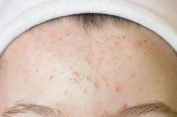 Thủ phạm gây ra mụn trên trán và cách ngăn chặn chúng hiệu quả