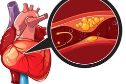 Đau ngực khi đá bóng, người đàn ông 32 tuổi phát hiện nhồi máu cơ tim