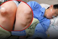 Người đàn ông phát hiện ung thư từ một dấu hiệu bất thường ở chân