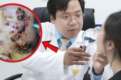 Tin lời sạch mụn sau 3 ngày, nữ sinh 20 tuổi mặt sưng nề 'như ong đốt'