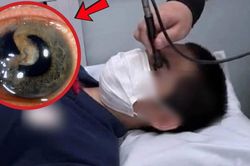 Bạn bật ô che mưa, nam sinh bị vỡ nhãn cầu có thể mù vĩnh viễn