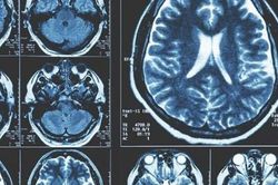 Mở hướng tiếp cận mới trong nghiên cứu điều trị Parkinson