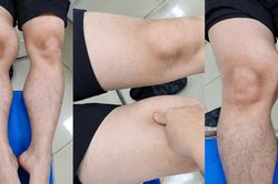 Đùi phình to như quả bóng suốt 1 năm, đi khám phát hiện ung thư hiếm gặp