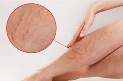 Tưởng mỏi chân do đứng bán hàng, đi khám phát hiện tĩnh mạch hiển suy nặng