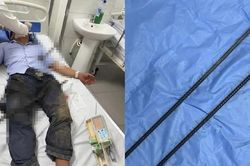 Báo động đỏ nội viện cứu sống bệnh nhân bị hai thanh sắt xuyên thấu