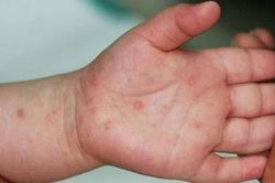 Cảnh giác dấu hiệu biến chứng tay chân miệng ở trẻ nhỏ