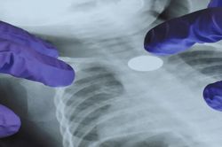 Một đột biến gene khiến nguy cơ ung thư phổi tăng 60 lần