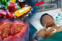 Uống nhiều nước ngọt có làm tăng nguy cơ ung thư gan?