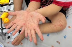 Bệnh tay chân miệng ở TP.HCM tăng mạnh, nhiều ca chuyển nặng