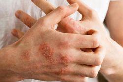 Ngứa kéo dài có thể là dấu hiệu của bệnh gì?