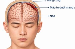 Đau đầu kéo dài 7 ngày, nam bệnh nhân 32 tuổi phát hiện tụ máu dưới màng cứng dày 19 mm