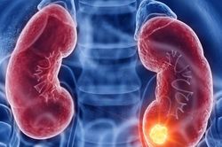 Chuyên gia cảnh báo nguy cơ suy thận nếu tiêu thụ quá nhiều loại dưỡng chất này