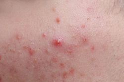Sai lầm khiến trứng cá đỏ tái phát liên tục và 5 bước chăm sóc da dịu nhẹ
