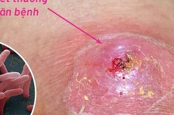 Hai bệnh nhân nguy kịch vì Whitmore, cảnh báo nguy cơ sau mưa lũ