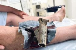 Chân chống xe máy găm cẳng chân, người đàn ông phải mang cả vào phòng cấp cứu