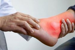 Bệnh gout không chỉ do ăn uống