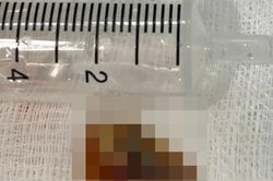 Mảnh xương 2 cm nằm sâu trong phế quản, gây tắc phổi và nhiều ổ mủ