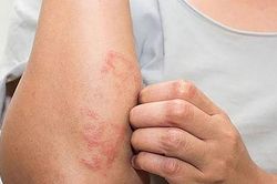 Mày đay mạn tính: Nhận diện đúng để điều trị hiệu quả