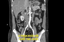 Lấy trọn khối u thận hiếm gặp qua phẫu thuật nội soi