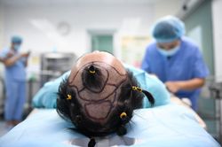 Mới 20, 30 tuổi đã rụng tóc, hói đầu: Bác sĩ giải thích nguyên nhân