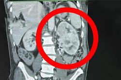 Có dấu hiệu này nhưng không đi khám, người đàn ông 64 tuổi mắc ung thư giai đoạn 4