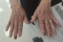 Móng tay dài, cặn bẩn đầy kẽ khiến người phụ nữ loét giác mạc