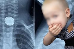 Bé 3 tuổi nuốt pin cúc áo, thực quản bị ăn mòn nghiêm trọng
