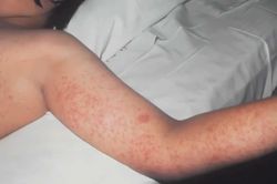 Bang Pennsylvania, Mỹ bùng phát dịch sởi