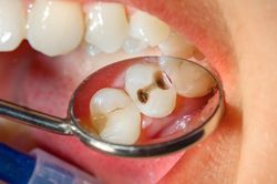 4 thói quen thường gặp có thể khiến răng sâu nhanh hơn