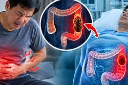 Đau bụng âm ỉ, người đàn ông nhập viện khi đại tràng đã tắc hoàn toàn