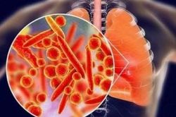 Nhân viên y tế ở Nga tử vong do viêm phổi: Có đáng lo ngại?