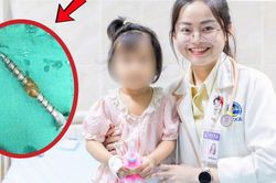 Bé gái 30 tháng tuổi suýt thủng đường tiêu hóa vì nuốt đinh vít 3cm khi chơi