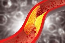 Thói quen khiến mỡ máu tăng vọt, dân nhậu hay làm nhưng không biết