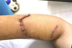 Sức khỏe nữ sinh lớp 9 bị bạn dùng dao tấn công gây đa thương tích ở Đắk Lắk