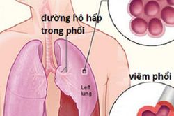 5 cách giúp chủ động phòng ngừa viêm phổi khi chuyển mùa