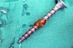 Người lớn lơ là, bé gái 30 tháng tuổi nuốt đinh vít dài 3cm