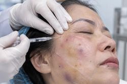 Biến chứng nguy hiểm sau nhiều năm tiêm filler không rõ nguồn gốc