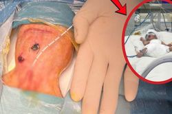 Bé trai sinh non 700 gram thủng ruột tự phát đặc biệt nguy kịch