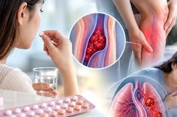 Phụ nữ thừa cân, ít vận động cần lưu ý nguy cơ huyết khối khi dùng thuốc tránh thai