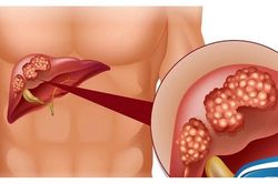 5 dấu hiệu cảnh báo ung thư gan khi bệnh đã tiến triển