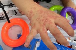 TPHCM: Ca tay chân miệng tăng mạnh, nhiều trẻ đồng nhiễm virus hô hấp
